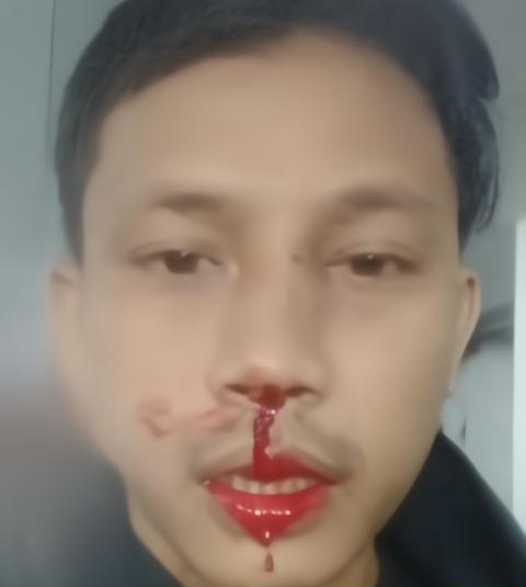 Salah seorang mahasiswa yang menjadi korban kekerasan penyerangan sekelompok preman.