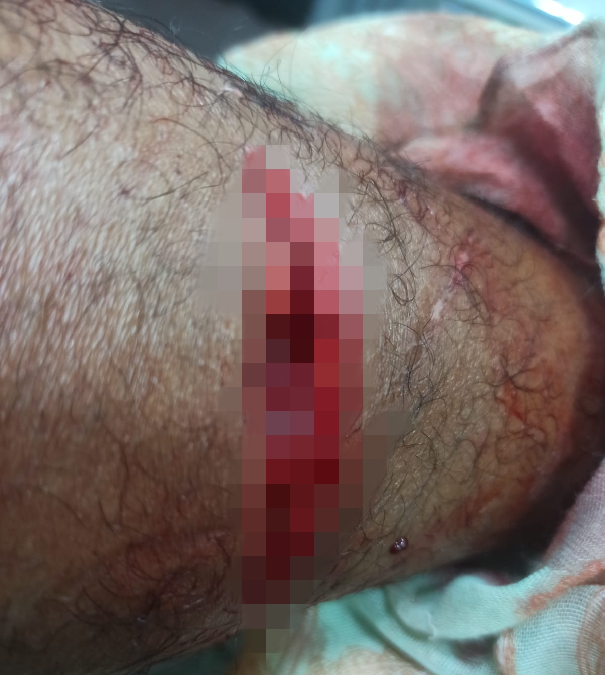 Korban Salah Sasaran OTK Berharap, Siapapun Yang Terlibat Segera di Ungkap
